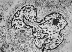 M,5y. | rhabdomyosarcoma vestibuli oris M,5y. | rhabdomyosarcoma vestibuli oris